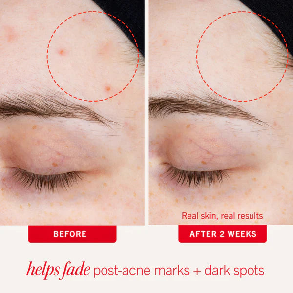 Ultimate Acne Solutions Routine - Image 13