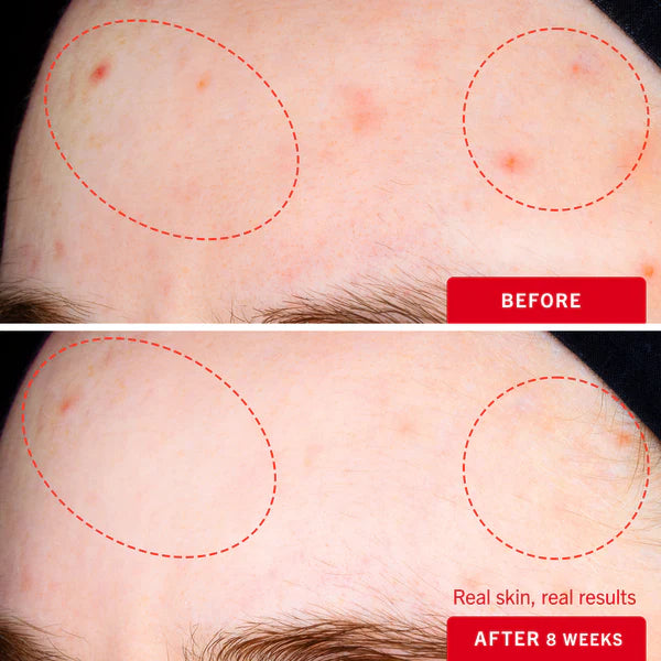 Ultimate Acne Solutions Routine - Image 15