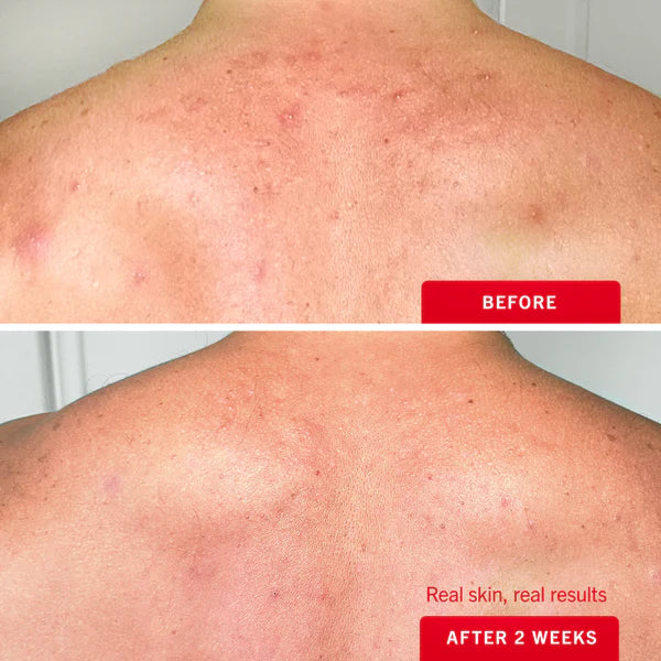 Ultimate Acne Solutions Routine - Image 5