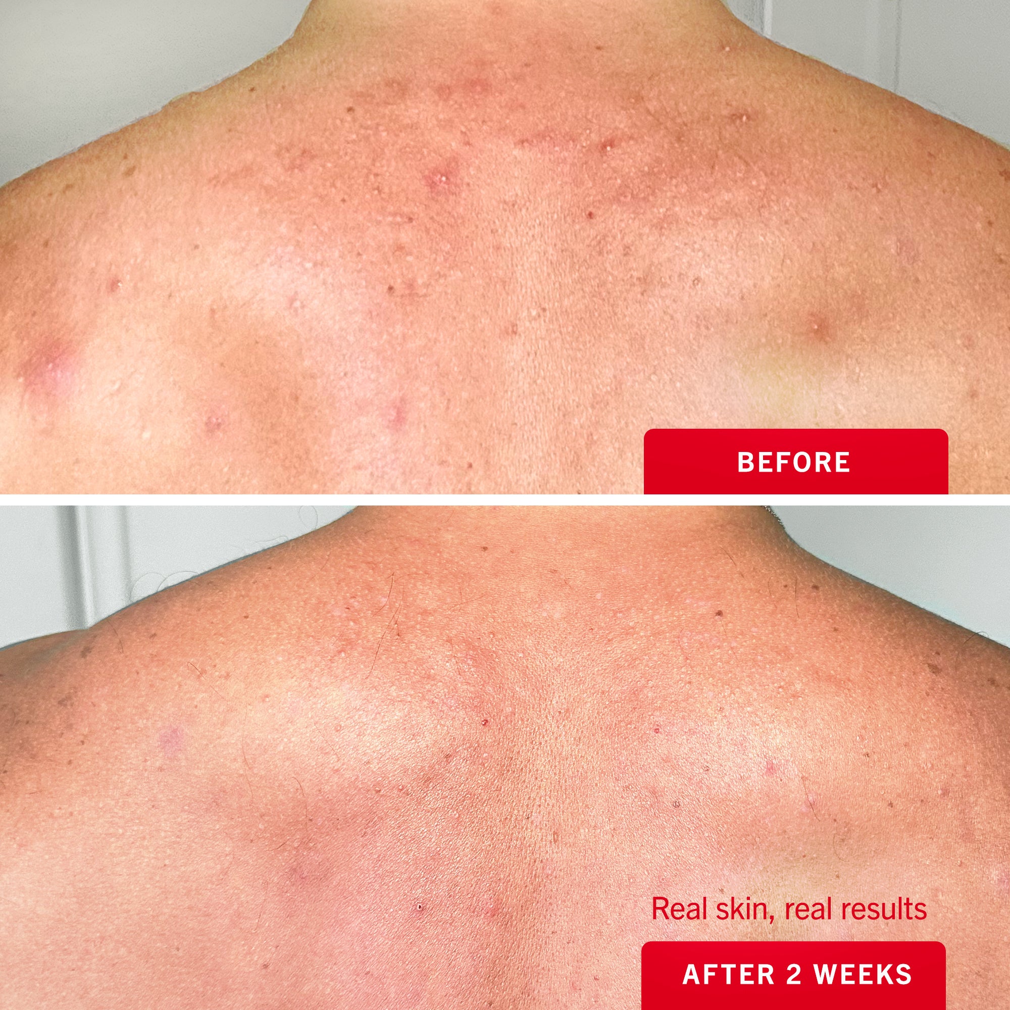 Body Acne Clearing Mist with 2% Salicylic Acid - Image 4