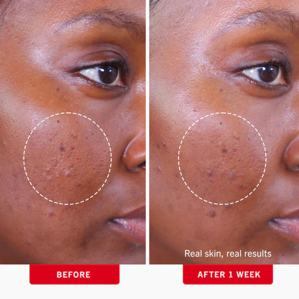 Ultimate Acne Solutions Routine - Image 21