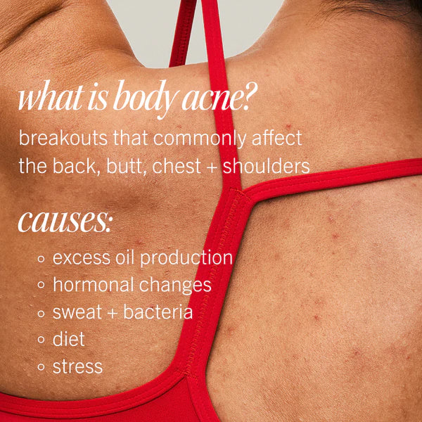 Ultimate Acne Solutions Routine - Image 9